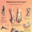 Lámina Malposiciones de los Pies (3B) (50x67 cm)